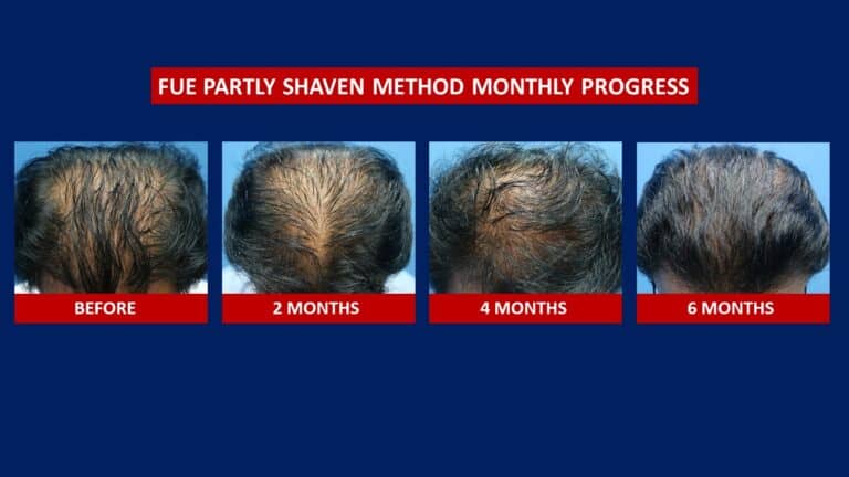 Hair Transplant Centre Malaysia, Before and After Monthly