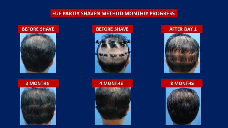 Hair Transplant Centre Malaysia, Before and After Monthly Donor area