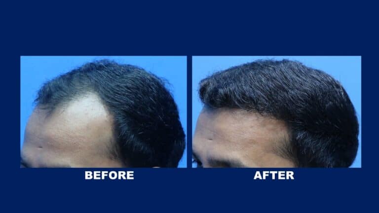 Hair Transplant Centre Malaysia, Before and After Temporal