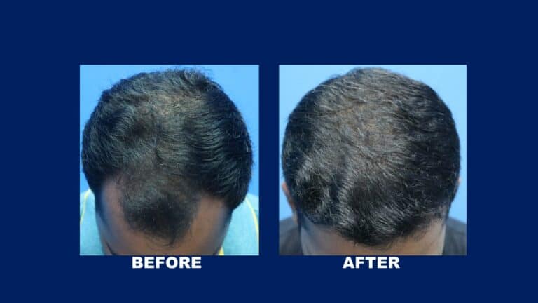 Hair Transplant Centre Malaysia, Before and After Midscalp