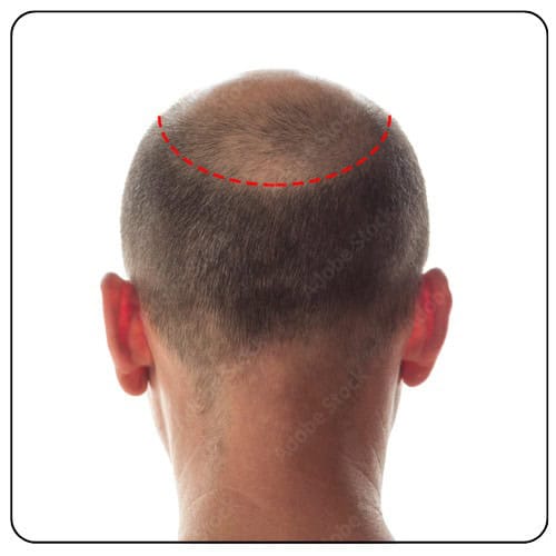 crown hair transplant