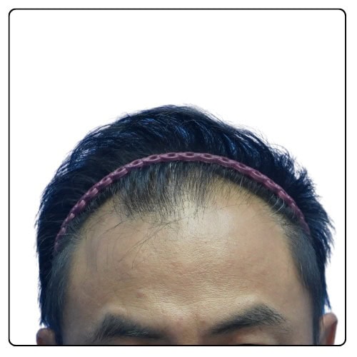 haihairline hair transplant