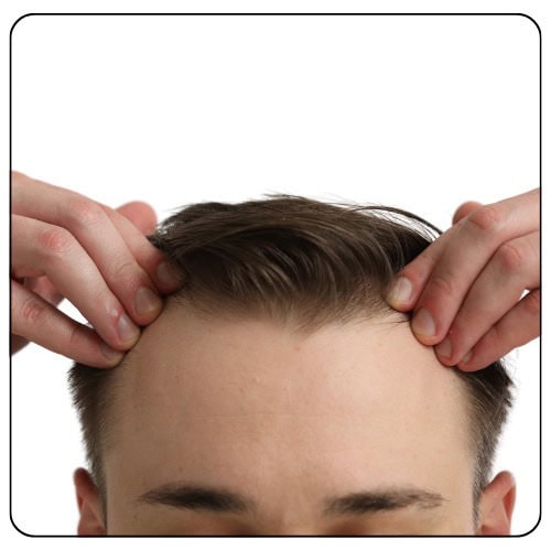 mshape hair transplant
