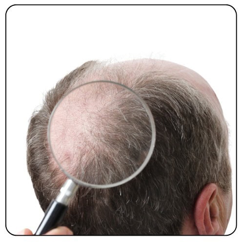 rrepair hair transplant