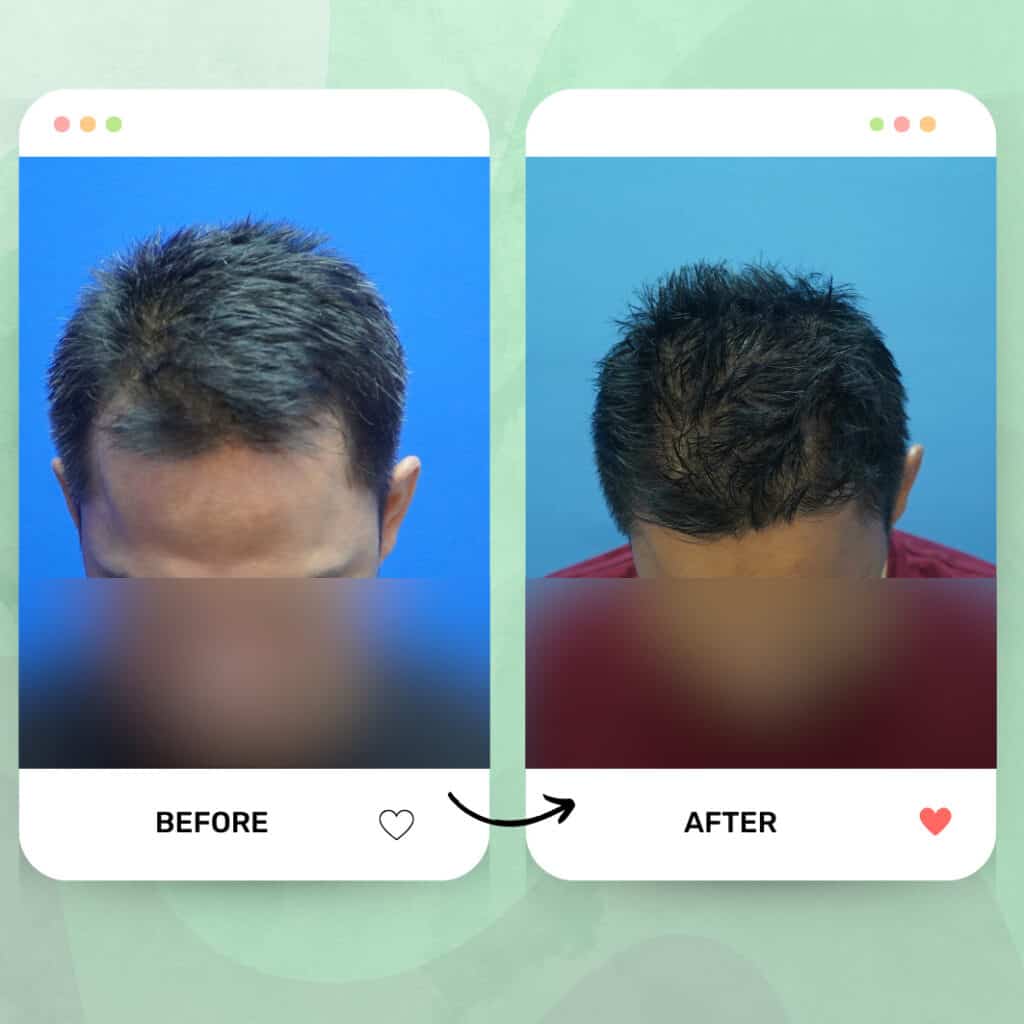 tanam rambut fue malaysia before after 1