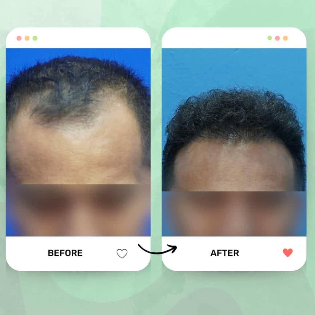 tanam rambut fue malaysia before after 3