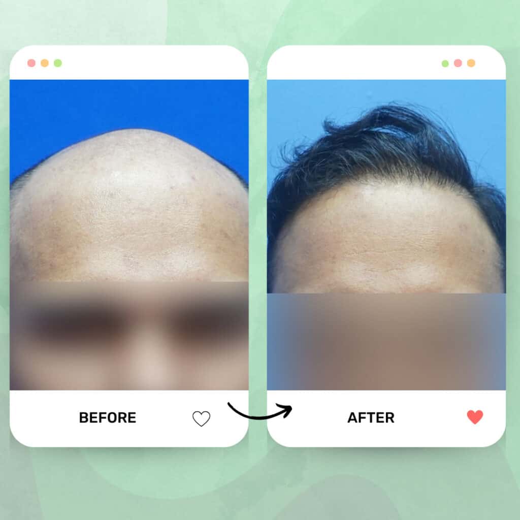 tanam rambut fue malaysia before after 4