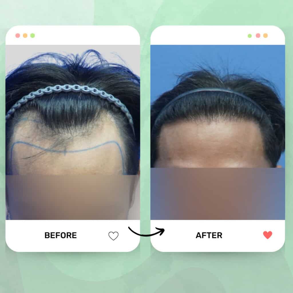 tanam rambut fue malaysia before after 5