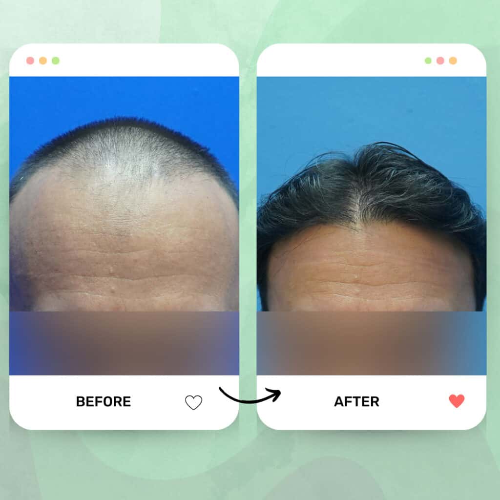 tanam rambut fue malaysia before after 6