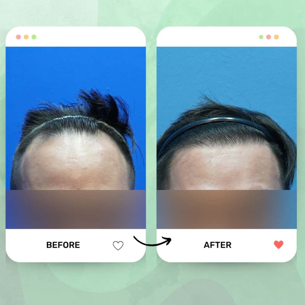 tanam rambut fue malaysia before after 7