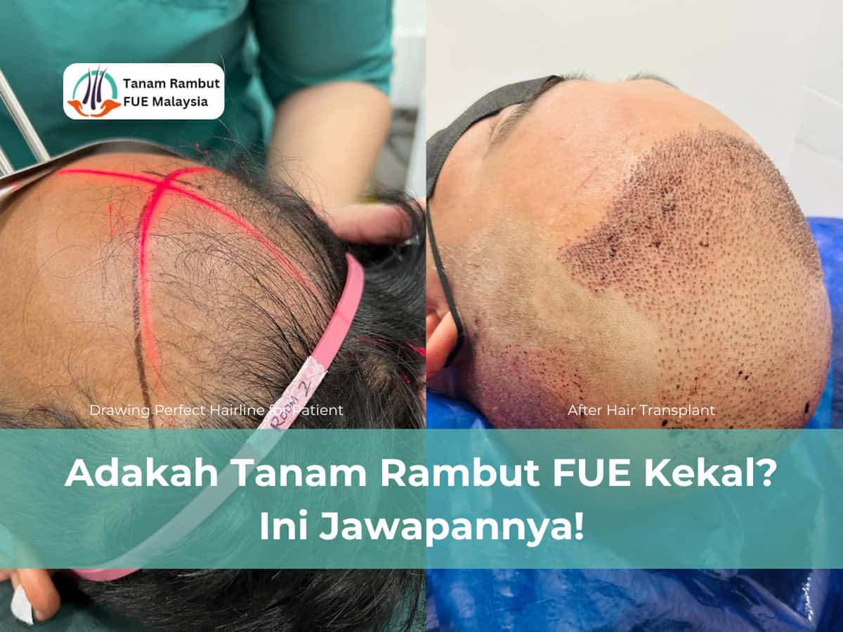 adakah tanam rambut fue kekal ini jawapannya!