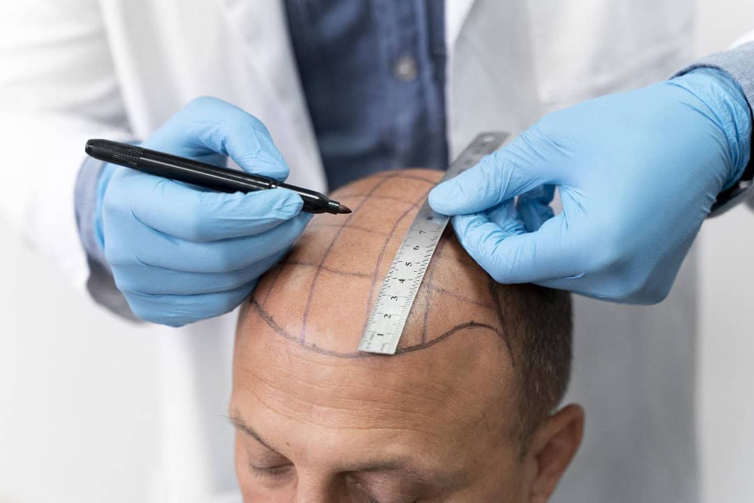 who is the ideal candidate for a hair transplant